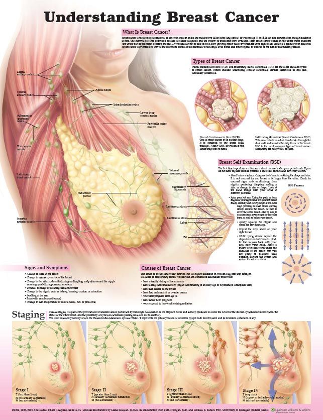 cancer photo: Understanding Breast Cancer Poster UnderstandingBreastCancer2lg_zps8524aebf.jpg