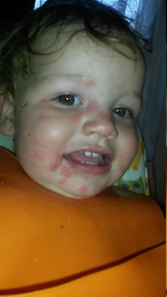 46+ Butternut Squash Dermatitis PNG certifiedchiq