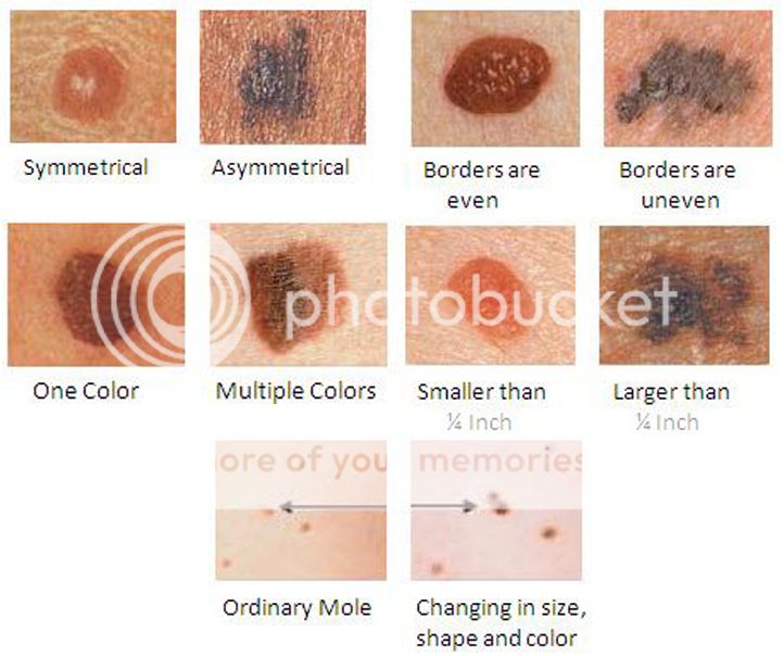 Skin Cancer | Orange Coast Dermatology | Mission Viejo | Rancho Santa ...